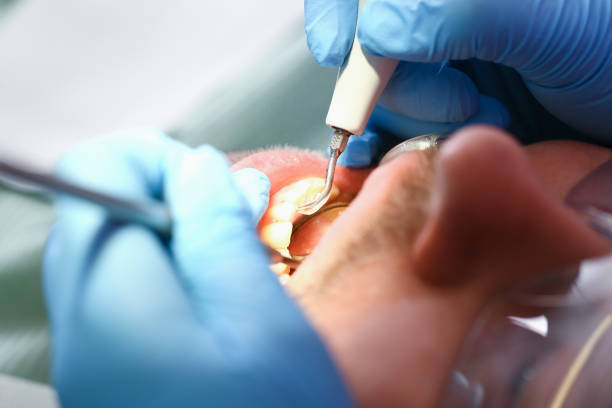 Best Emergency Root Canal Treatment in The Crossings, FL